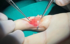 年轻小伙手指切割伤后手指麻木 创伤显微手外科异体神经修复指神经缺损助康复